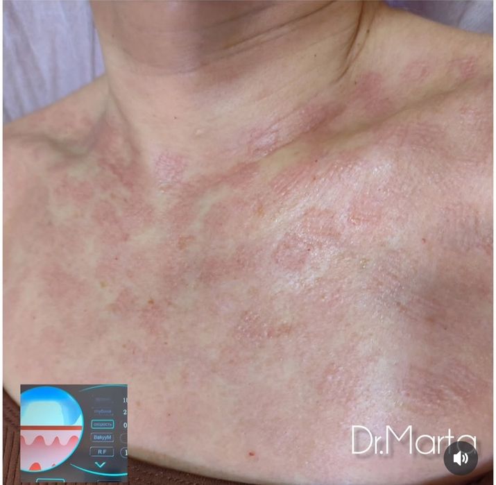 Мікроголковий рф,вакуумно-роліковий масаж в центрі та на Таїрова!