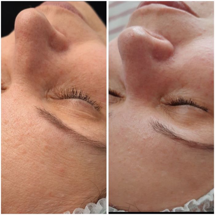 Холодна плазма НОВА розробка вчених Косметологічний апарат