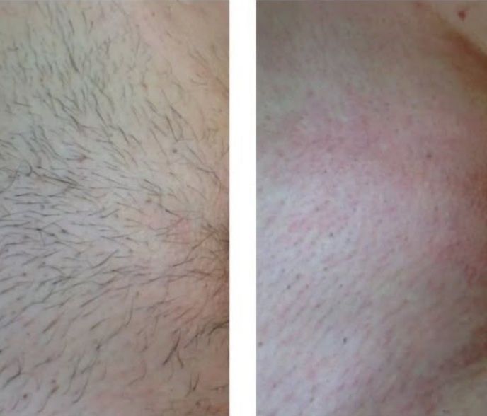 Депіляція (Піски) Депиляция воском(Пески)