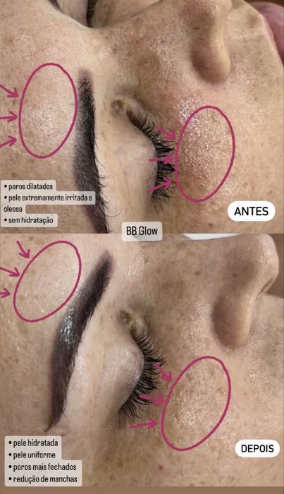 Extensao Pestanas e Microagulhamento Facial