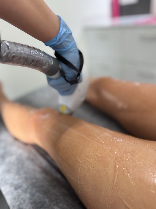 Laser do depilacji Primelease wynajem