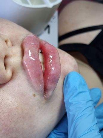 Увеличение губ. Мезотерапия, биоревитализация