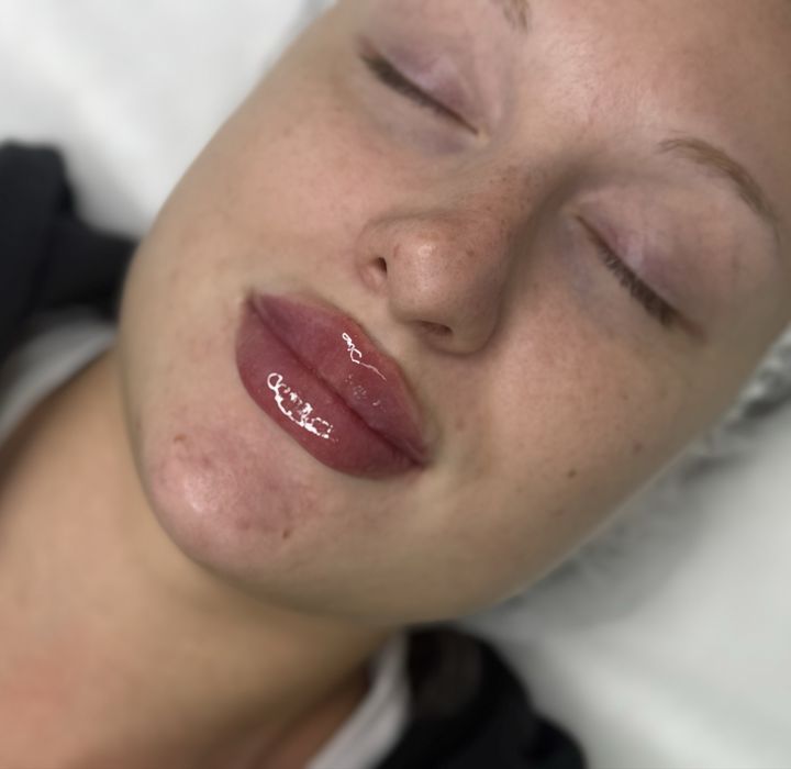 Збільшення губ,ботокс,мезотерапія,біоревіталізація,чистка обличчя