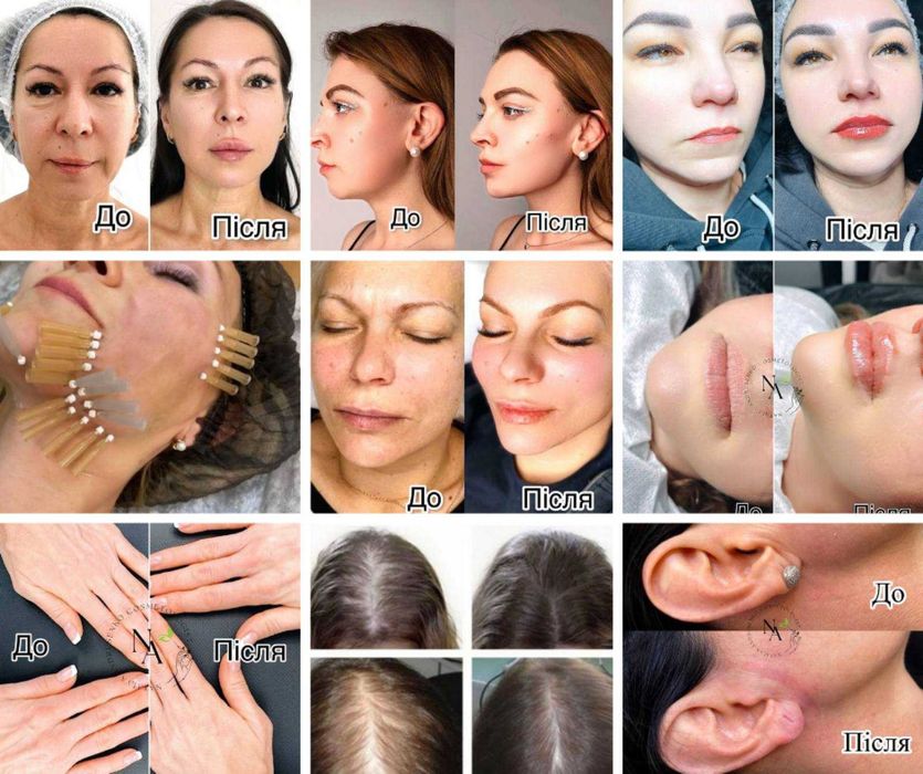 косметолог-дерматолог обличчя - ботокс філлери біоревіталізація