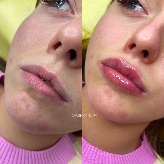 АКЦІЯ! Контурна пластика губ / збільшення губ / увеличение губ