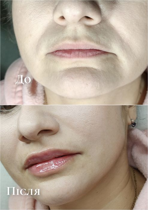 Контурна пластика губ!  2500грн.Потрібні моделі!