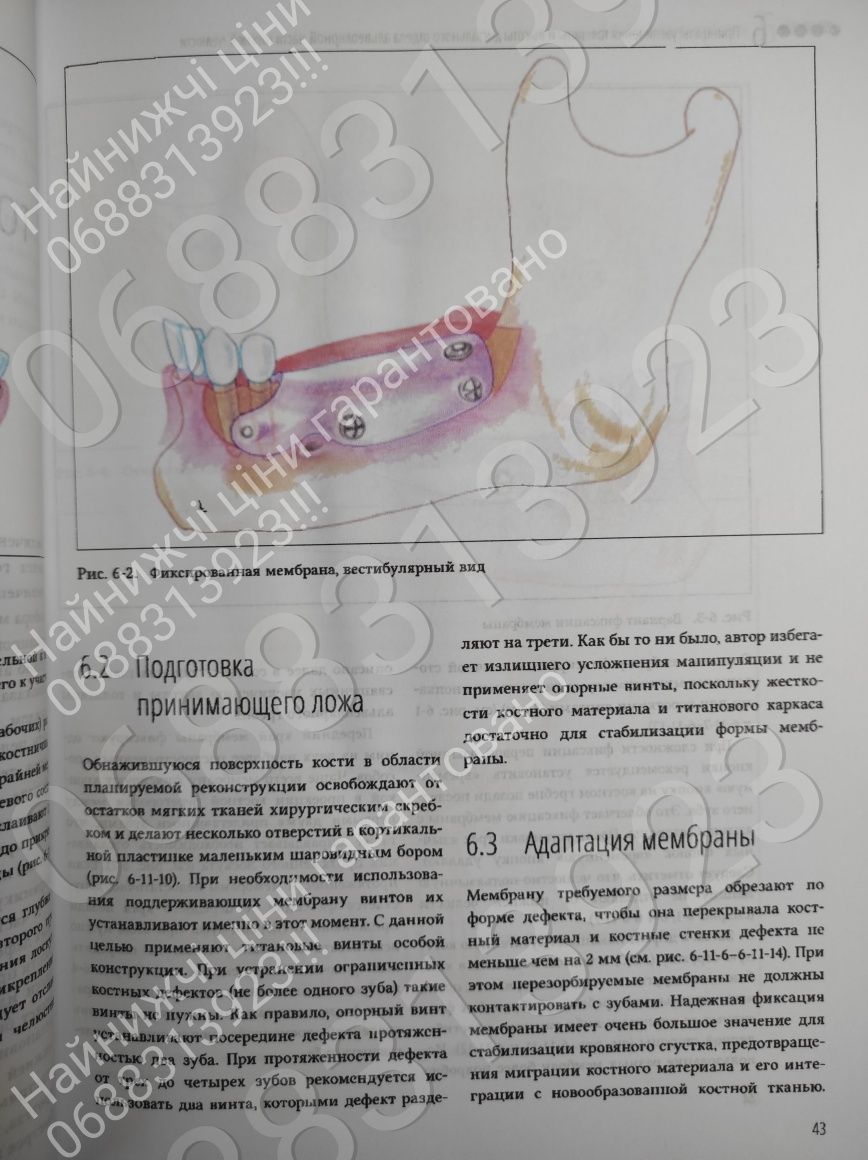 ДЕШЕВО!!! Увеличение висоти и толщини альвеолярного гребня,Иштван Урб.