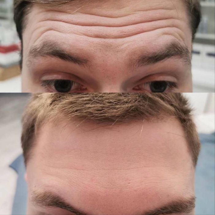 Ботокс для чоловіків