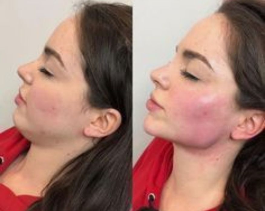 Увеличение губ - 1600. Колличество мест ограничено!