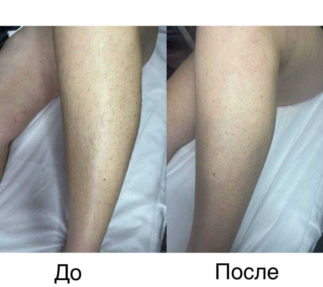 Шугаринг/депіляція воском