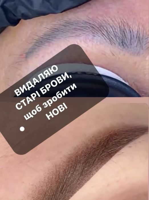 Видалення татуажа тату перманента лазером бровей стрелок губ ремувер