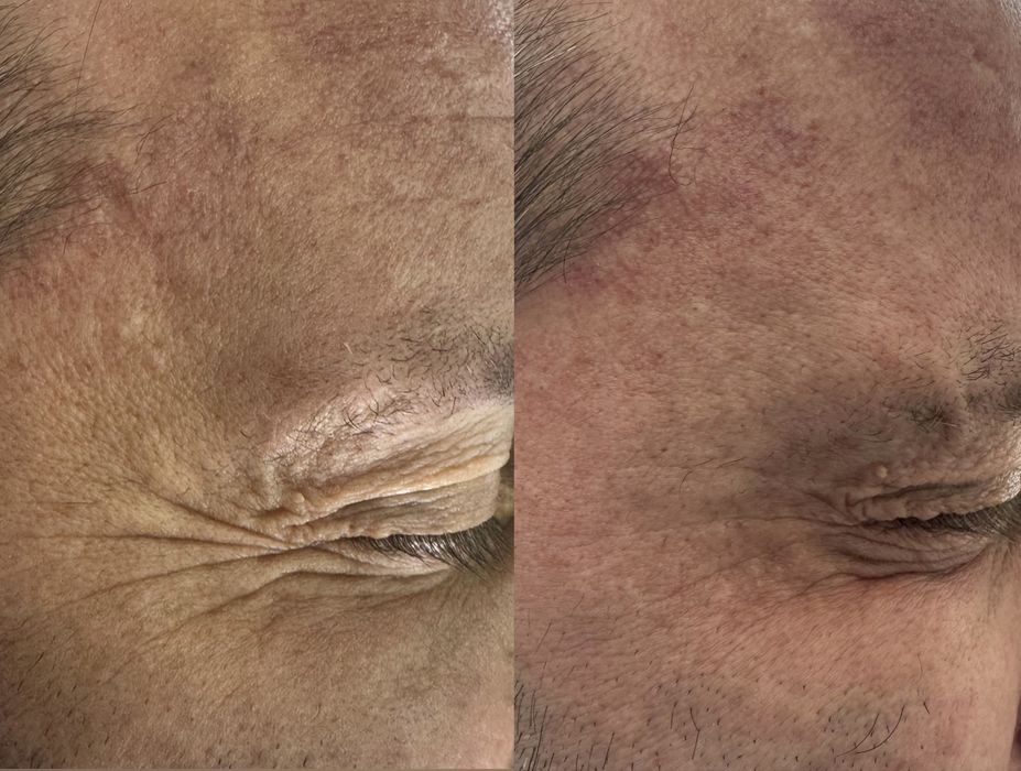 Botox Najniższa cena Botoks 150zł za 1 okolicę na zmarszczki botulina