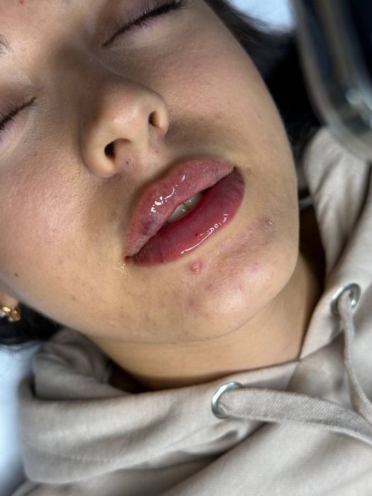 Збільшення губ,ботокс,мезотерапія,біоревіталізація,чистка обличчя