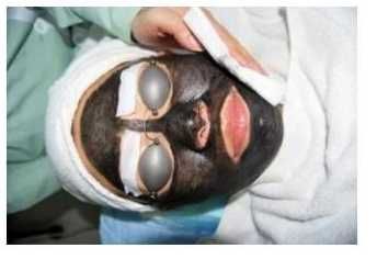 Laser, IPL  ,  RF , ND-Yag , pikosekundowy , peeling węglowy, tatuaż