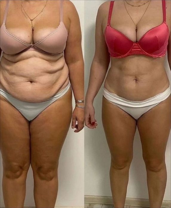 Modelowanie sylwetki i redukcja cellulitu – bez bólu i skalpela