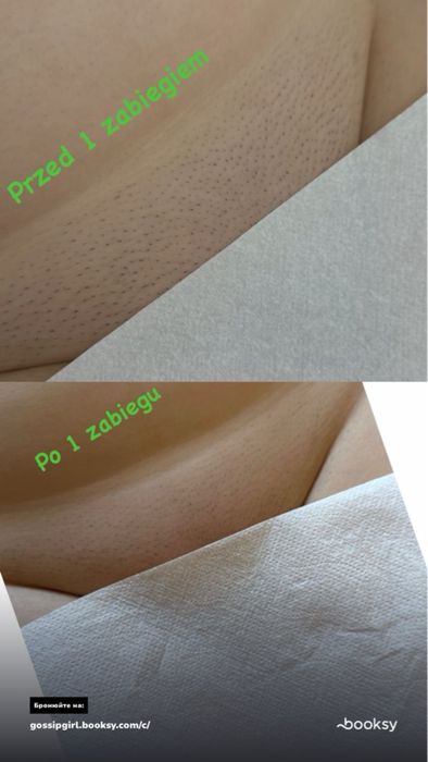 Depilacija Laserowa Centrum Szczecin