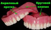 Инжекция Починка зубных протезов, Vertex Acron