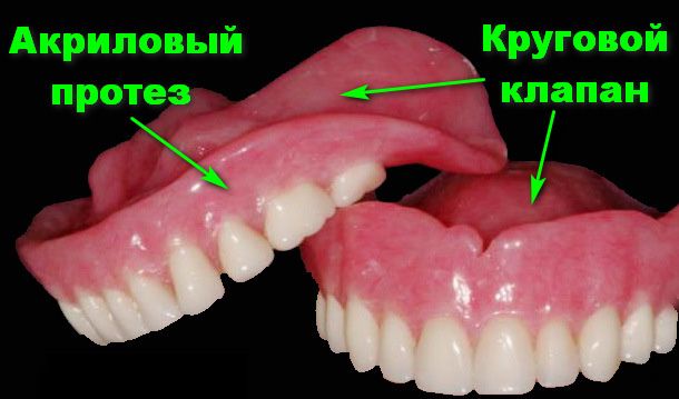Инжекция Починка зубных протезов, Vertex Acron и Acetal