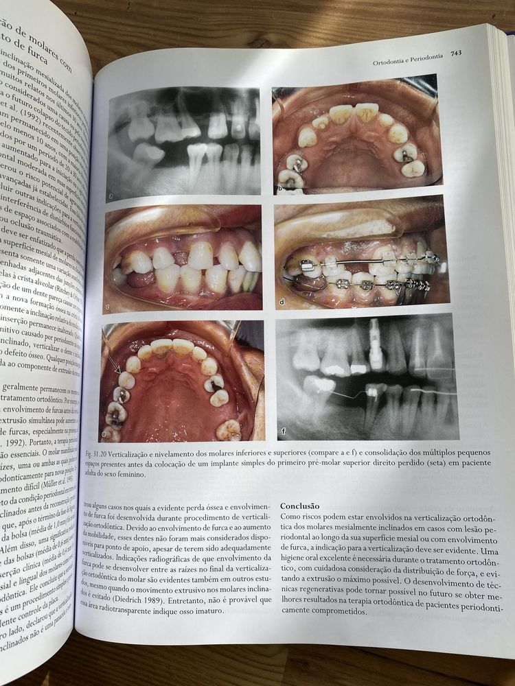 Livro Tratado de Periodontologia Clínica e Implantologia Oral