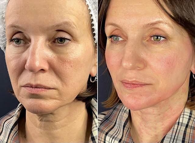 Косметолог- Дерматолог.Ботокс.Контурная пластика. Чистка лица. Массаж