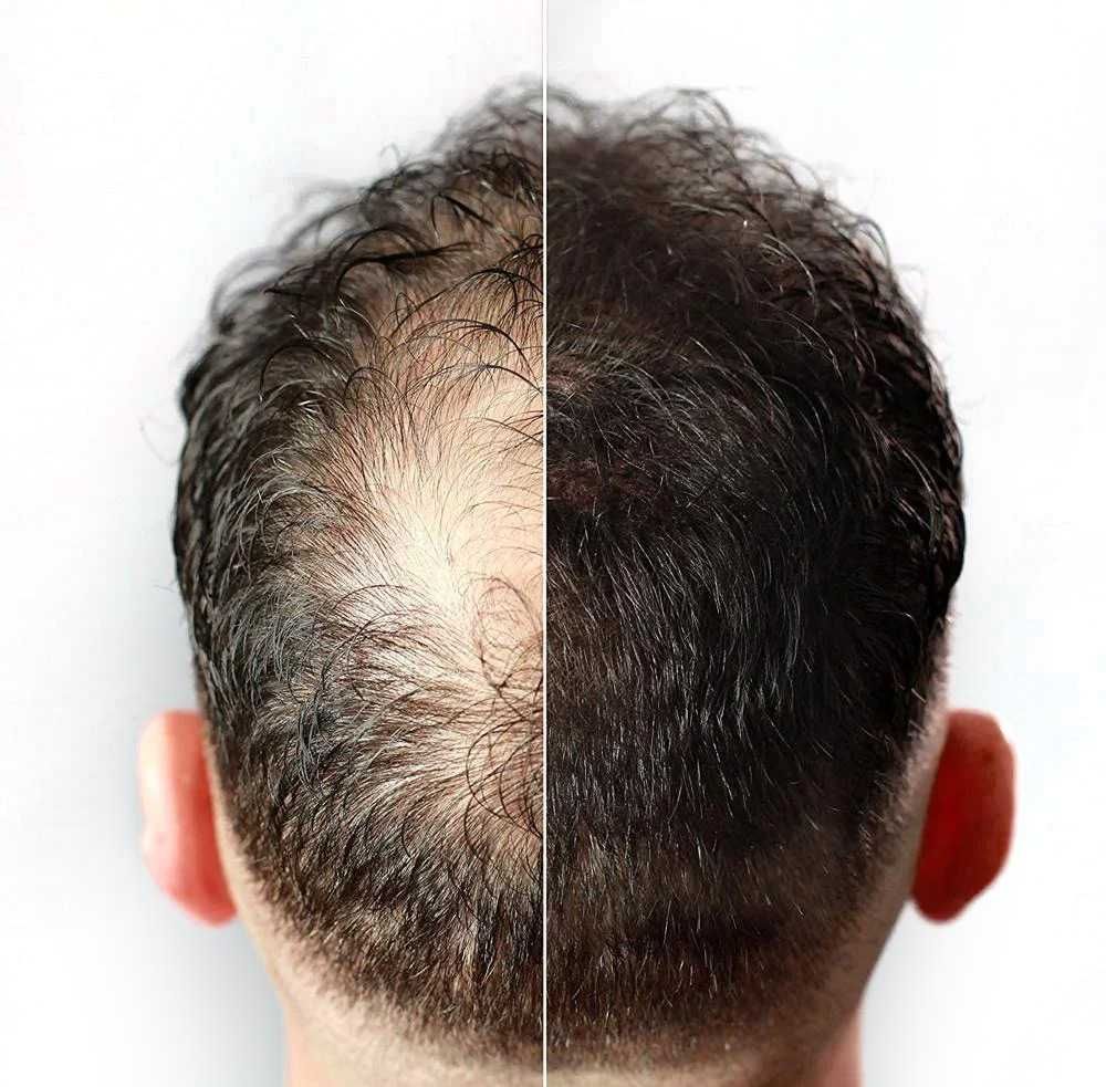 TOPPIK - Fibras capilares para queda e falhas de cabelo / calvice | Pó