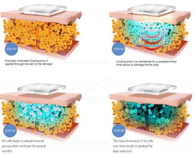 Vende-se máquina de Criolipólise em placas