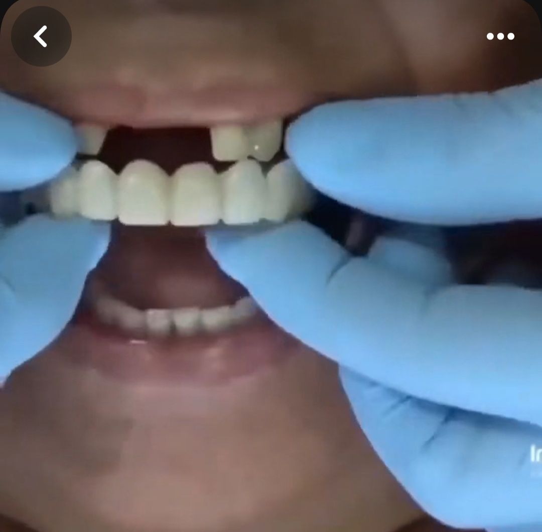 Две пары искусственных зубов. Вставные Зубы