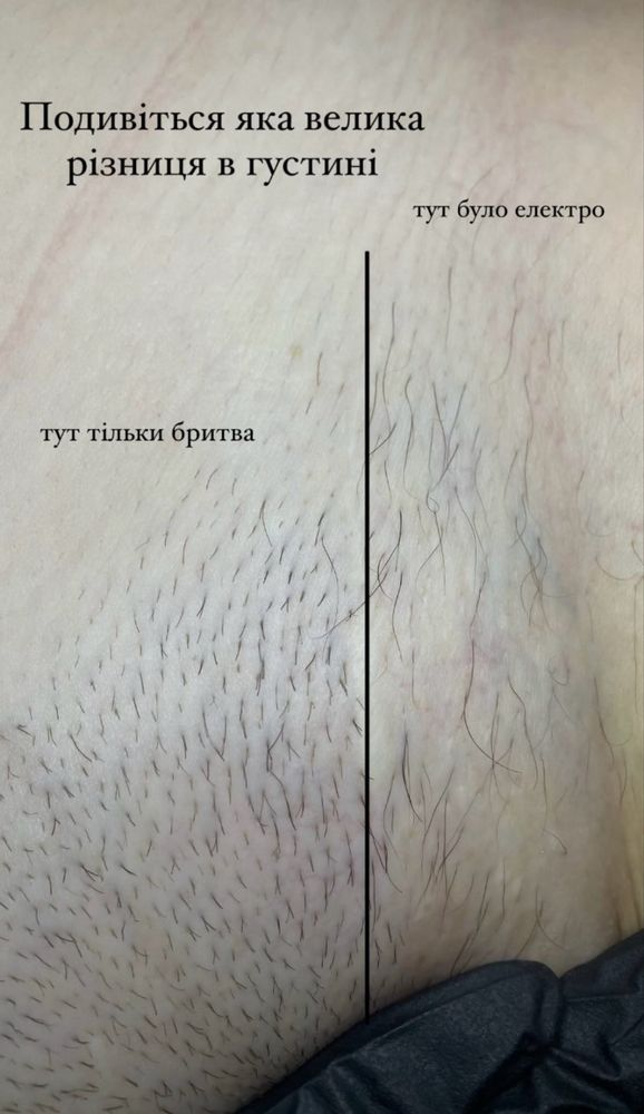 Електроепіляція-видалення небажаного волосся назавжди