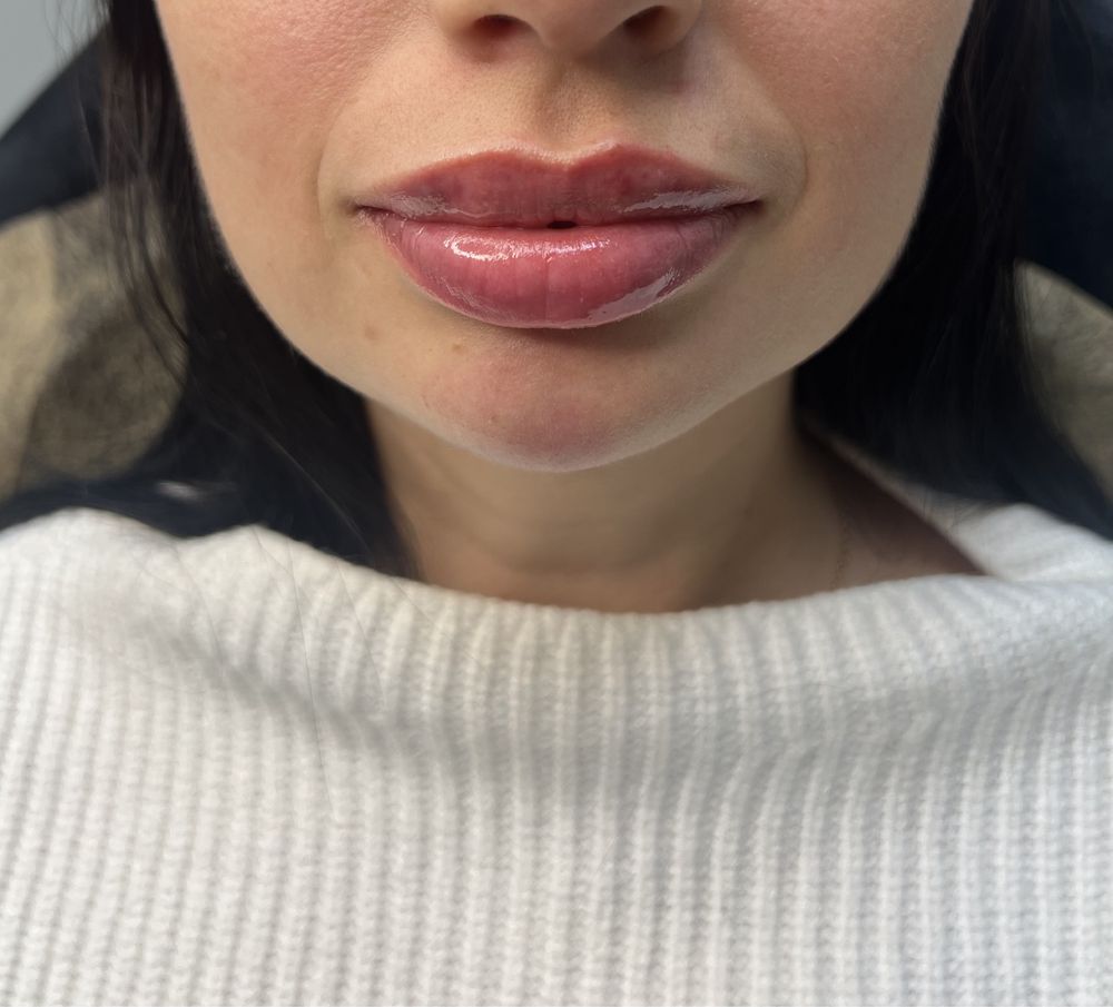 Моделі на Збільшення губ від 1500 Кп губ,ботокс.Углы Джоли,скулы.