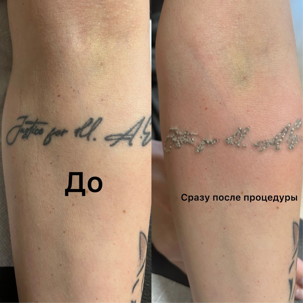 Удаление татуировок на неодимовом лазере, не дорого