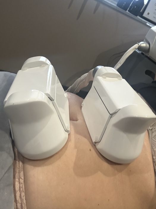 Kriolipoliza , RF mikroiglowa Fusionef Biotec
