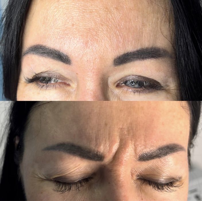 Ботокс| Все зоны | Одесса| Цент