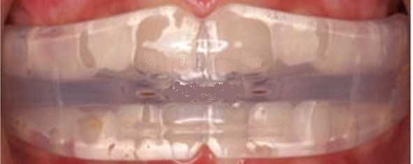 Ровные зубы (капа) ортодонтический трейнер