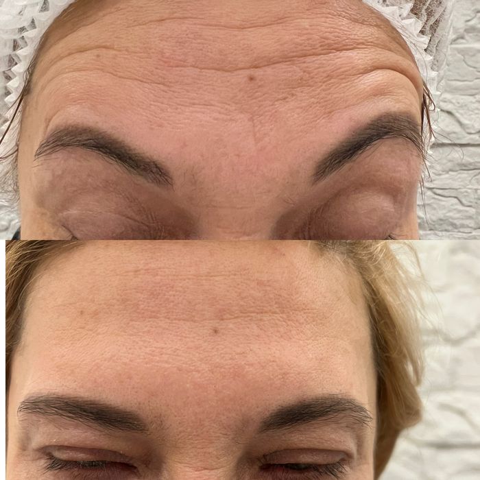 Косметолог. Увеличения Губ. Углы Джоли , скулы , Подбородок. Ботокс .