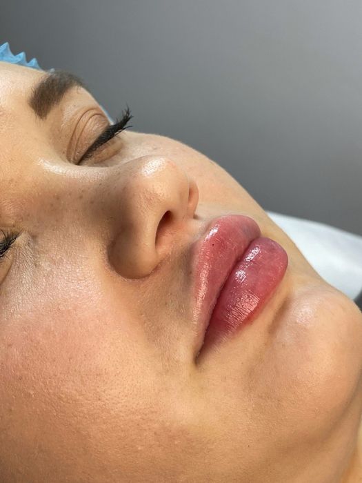 Контурна пластика губ від 3000 ботокс 1000