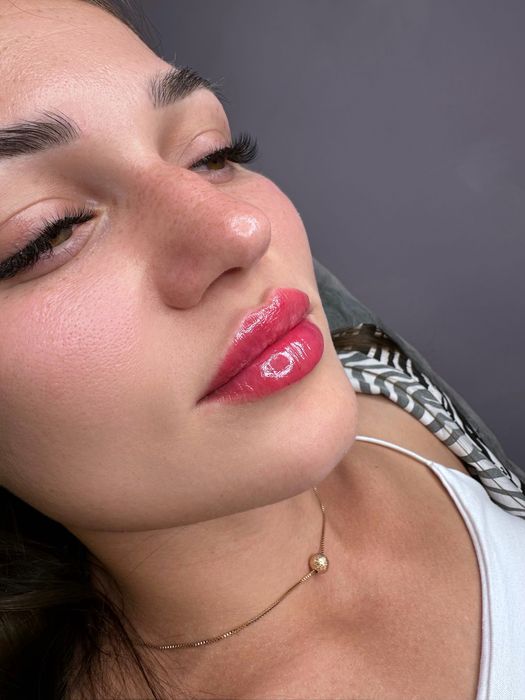 Збільшення губ та контурна пластика