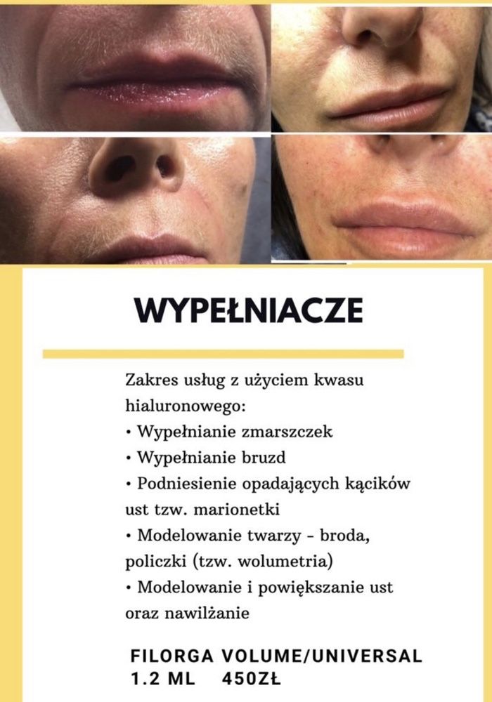 Powiększanie ust,stymulatory tkankowe,botox,Rzesy,lipoliza,dermapen,op