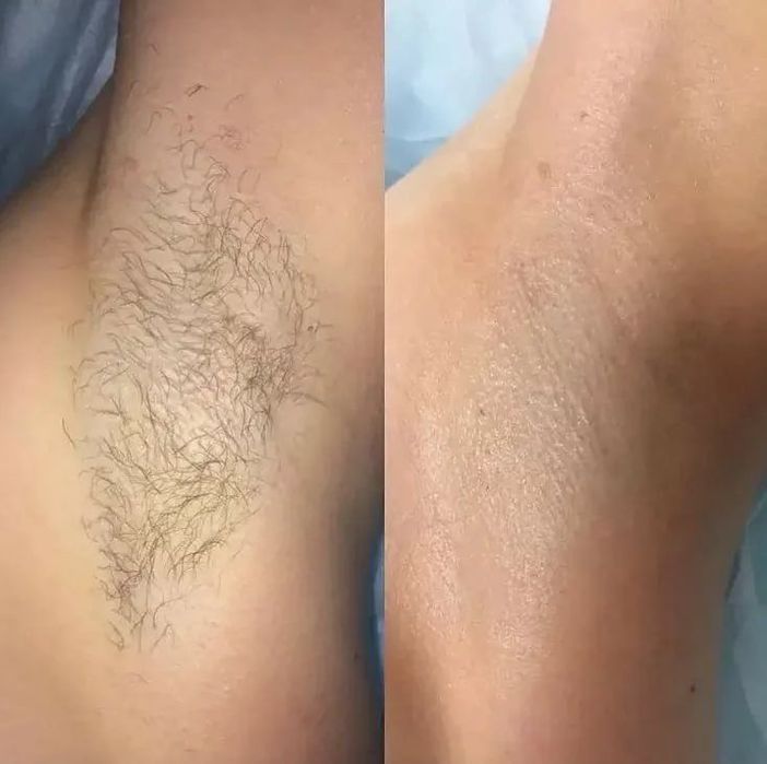 Депіляція/шугаринг