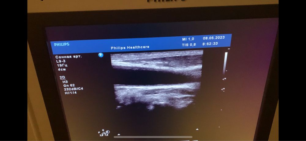 датчик узд узи philips лінійний l 9-3 до hd 11xe ,iu 22 та ie 33.