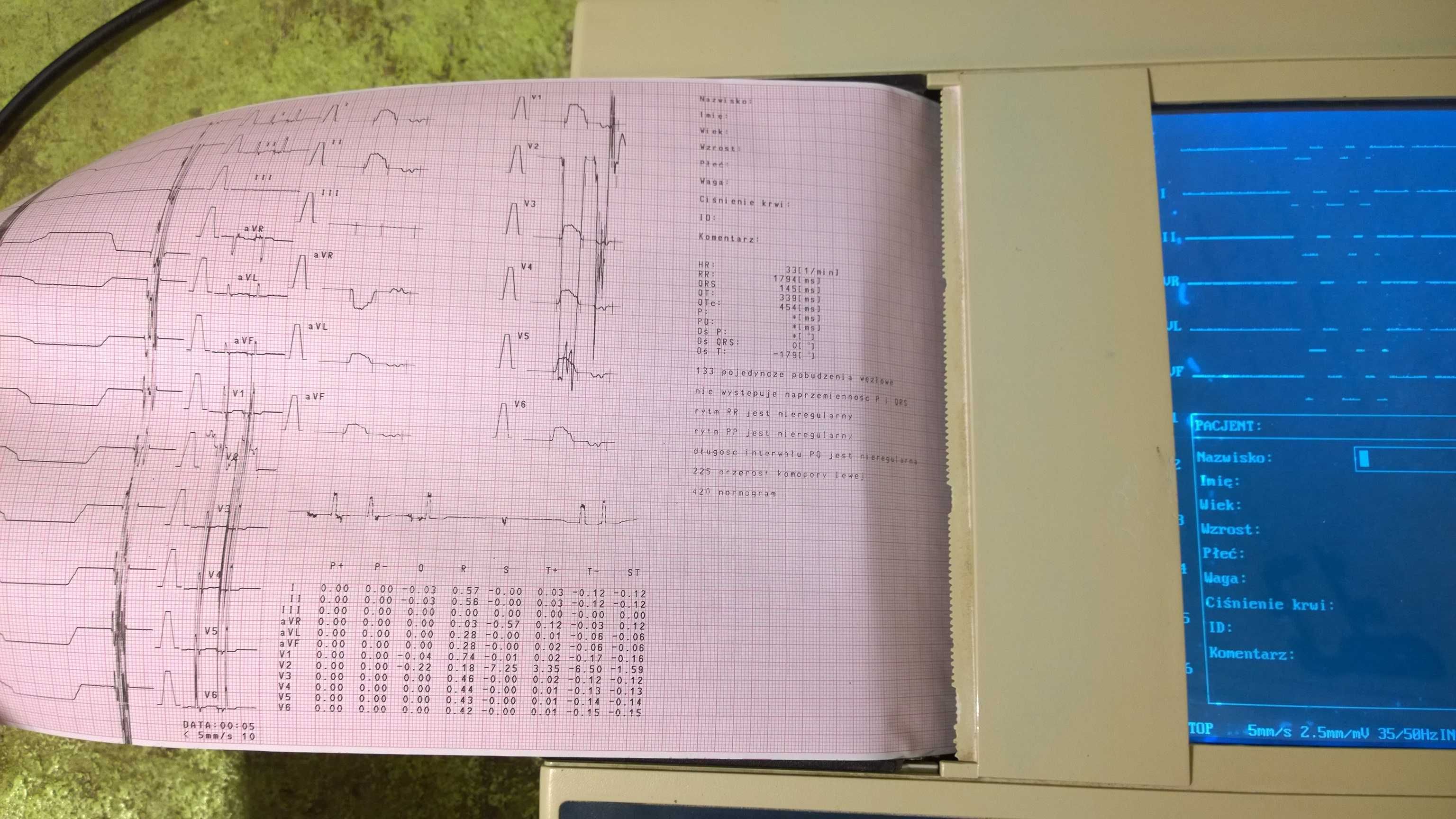 EKG - Elektrokardiograf