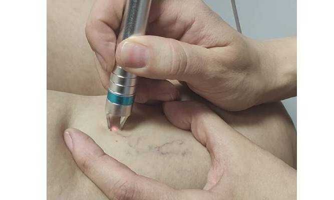 Laser IR-LIGHT na naczynka od Laser Hi-Tech