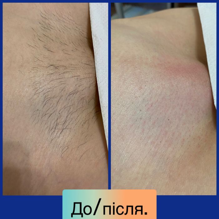 Шугаринг,воскова депіляція.