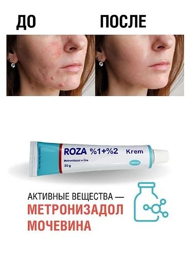 Крем ROZA %1+%2  (оригінал) Туреччина. Крем від розацеа, купероза,акне