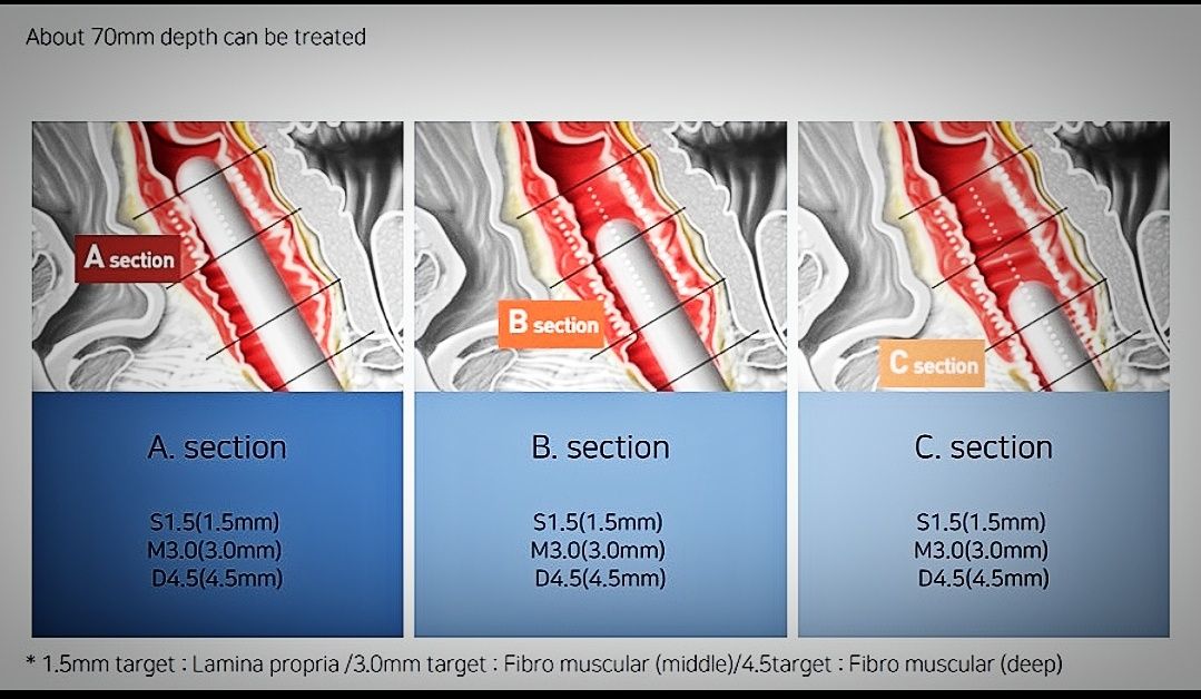 Máquina hifu 7D com tratamento vaginal genital