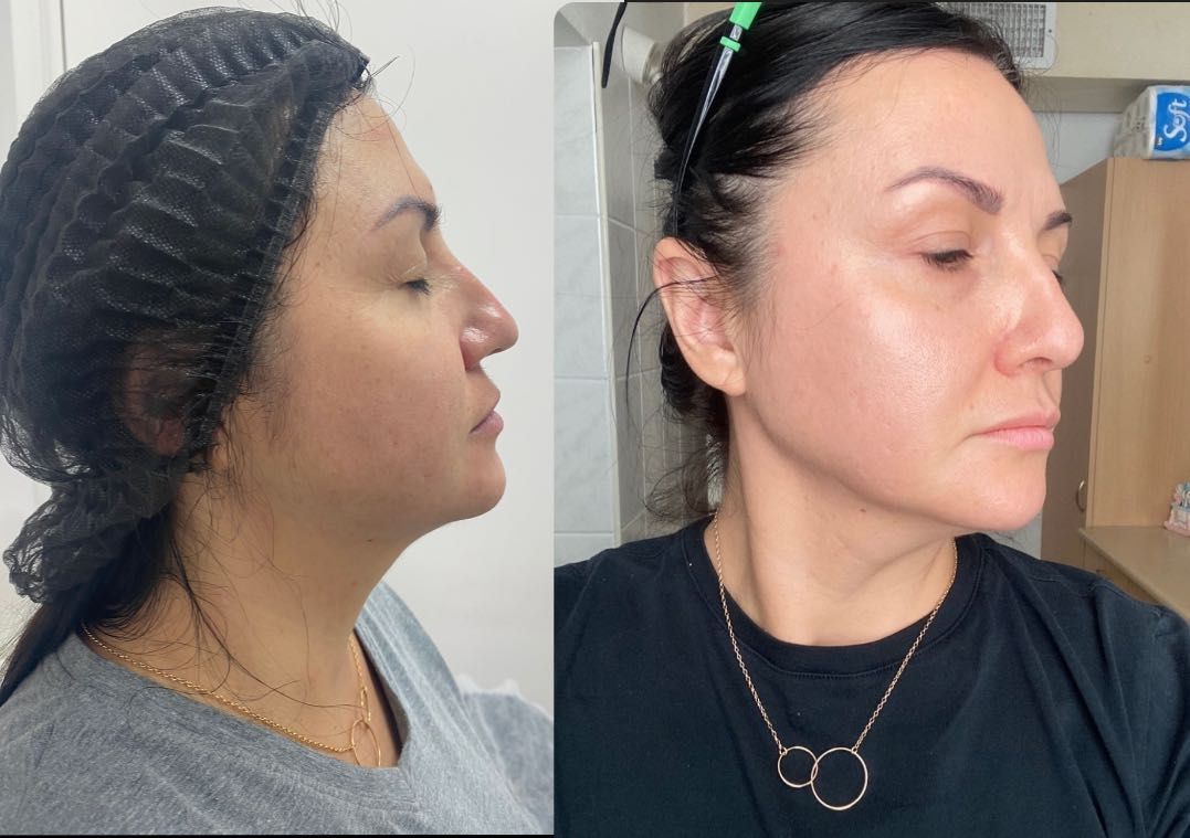 Botox/fullFace/контурная пластика/ губы