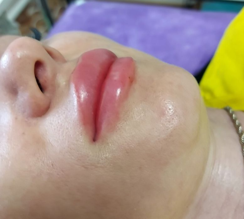 Пластика губ .Увеличение губ.Ботокс.