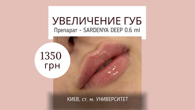 Увеличение губ - 1350 грн