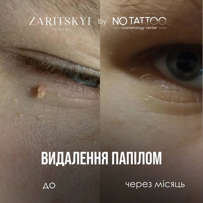 Лазерне видалення папілом