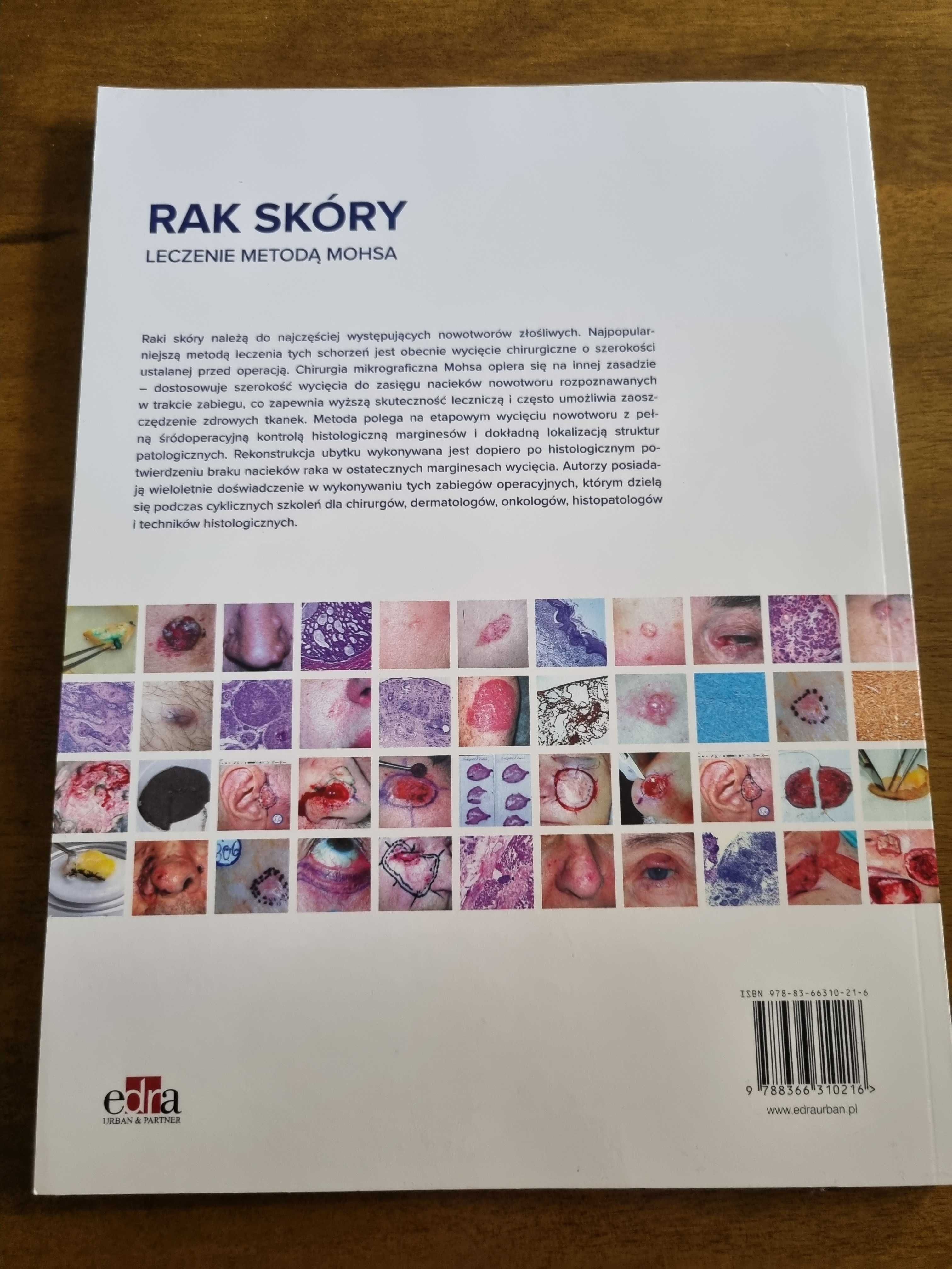 Nowa książka "Rak skóry leczenie metodą Mohsa" A. Bieniek, Z. Woźniak