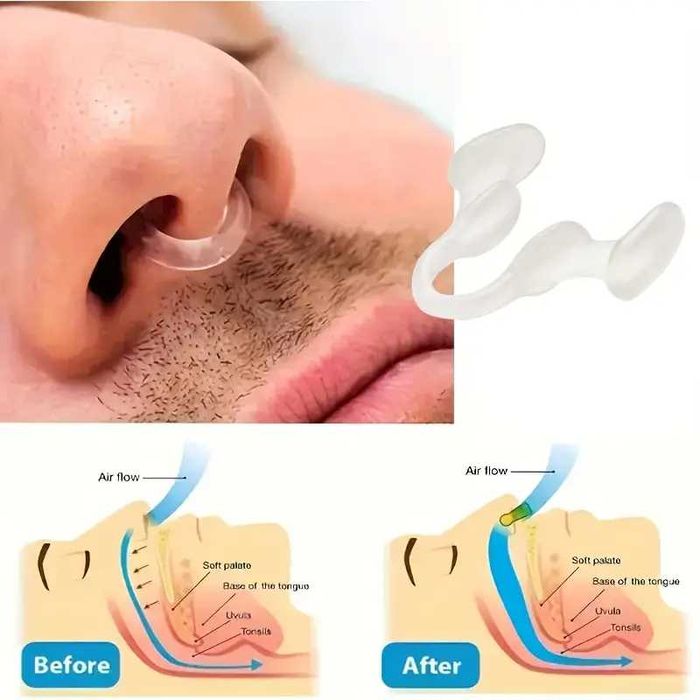 Dilatadores Nasais de Silicone Macio